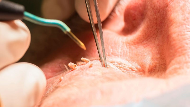 Anal warts