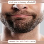 The best beard and mustache transplant doctor and a complete guide to having a thick and natural beard in Barad Clinic