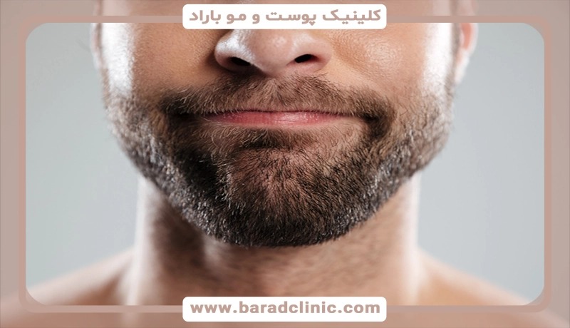 The best beard and mustache transplant doctor and a complete guide to having a thick and natural beard in Barad Clinic