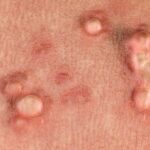 Anal warts