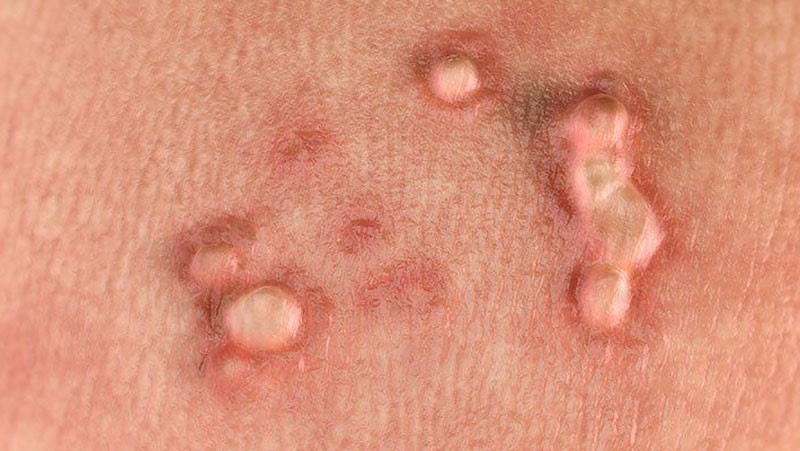 Anal warts